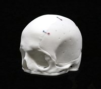 Acrylic Cranial Implant image 1