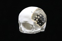 Acrylic Cranial Implant image 2